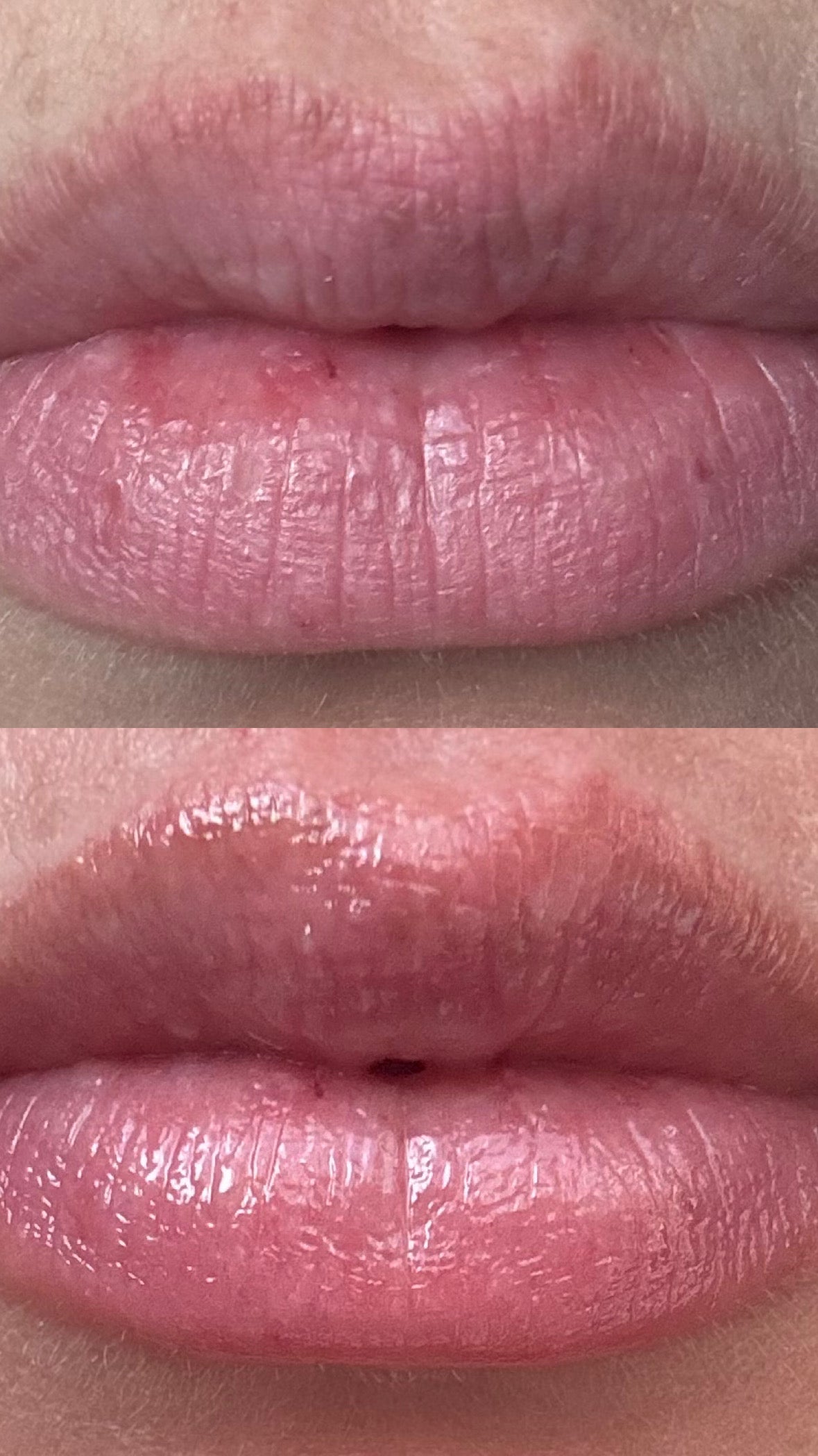 Lip Enhancer