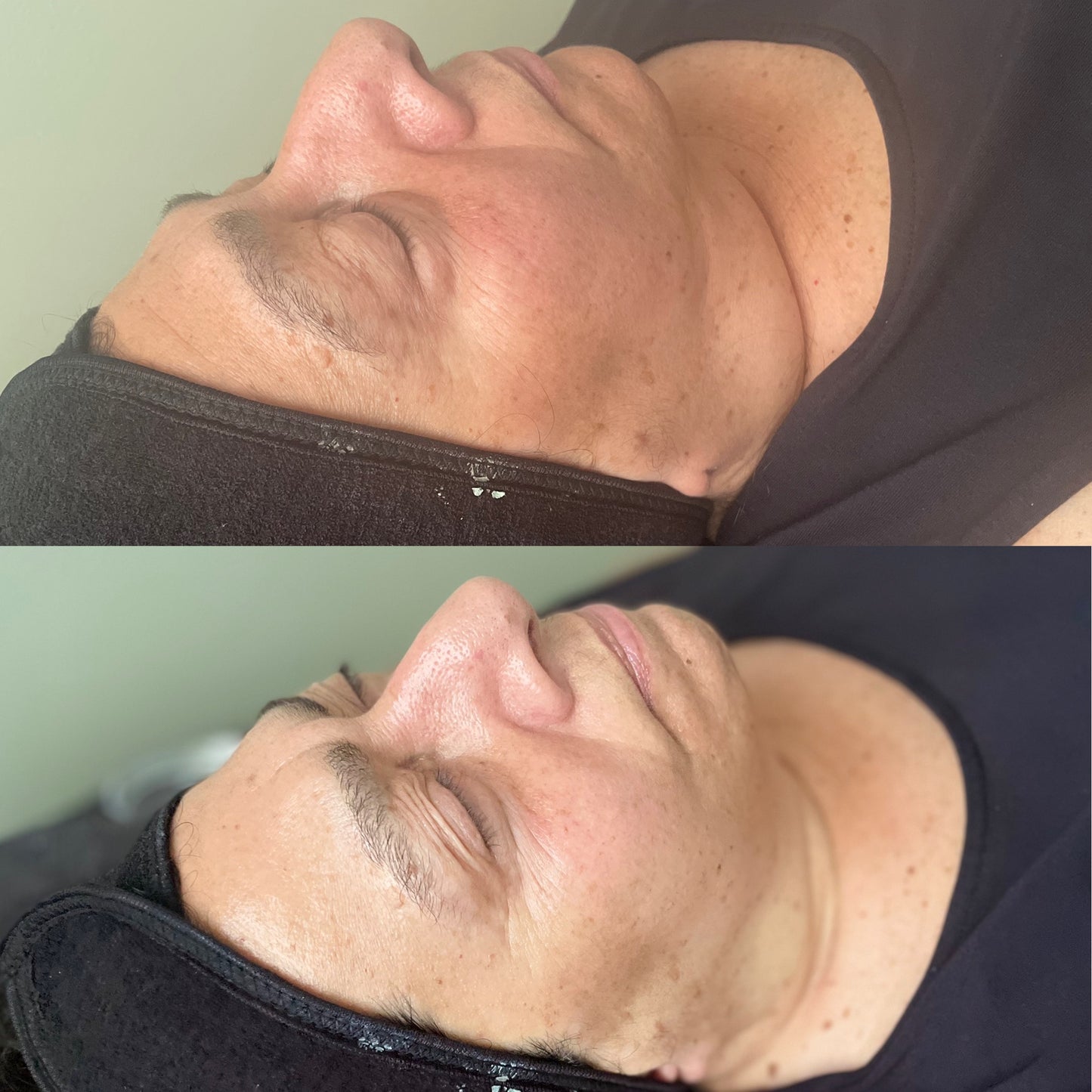 Chin & Neck Tightening Series (3)