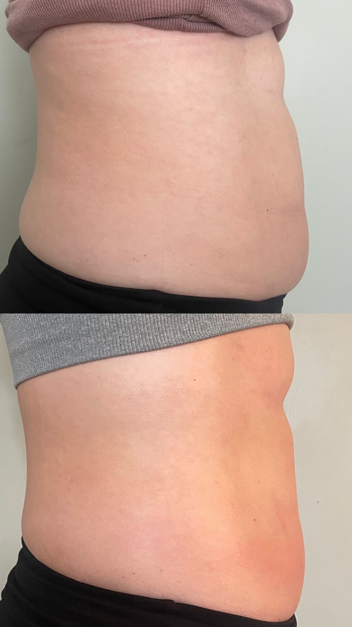 *REQUIRED* Body Sculpting Consultation