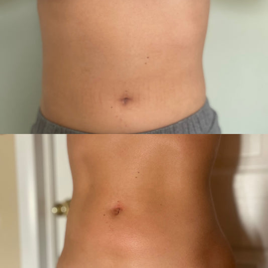 First Body Sculpting Treatment